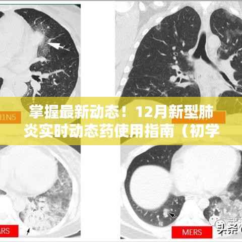 掌握最新动态!全面解读,新型肺炎药物使用指南(初学者进阶版)